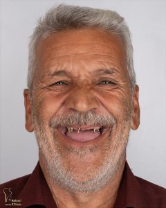ایمپلنت دندان مشهد