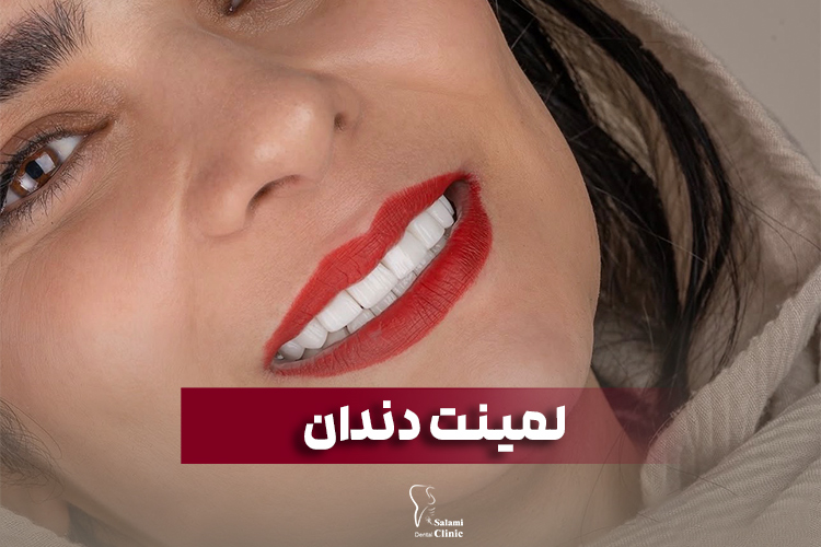 لمینت دندان در مشهد