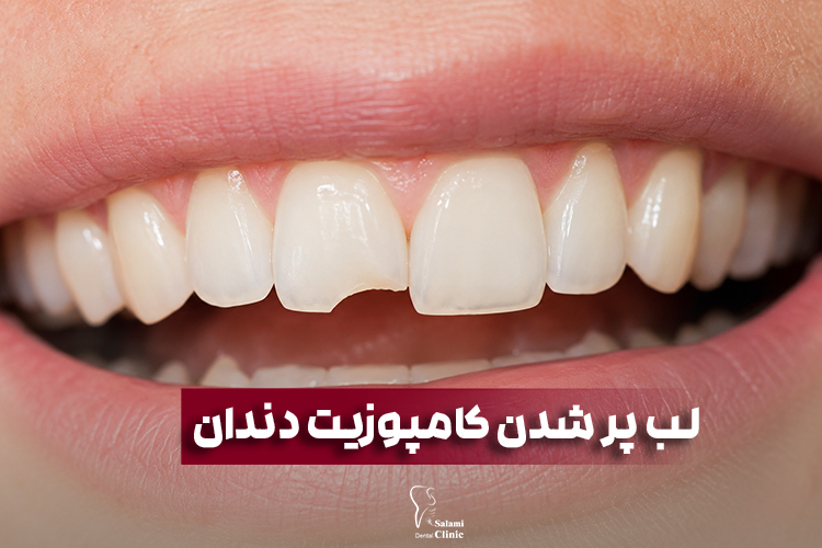 لب پر شدن کامپوزیت دندان